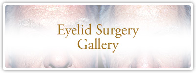 Eyelid Surgery Gallery