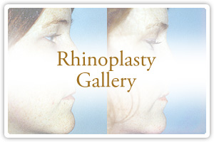 Rhinoplasty Gallery
