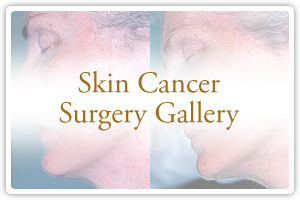 Skin Cancer Surgery Gallery