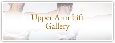Upper Arm Lift Gallery